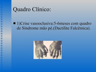 Quadro Clínico: 1)Crise vasooclusiva:5-6meses com quadro de Síndrome mão pé.(Dactilite Falcêmica). 