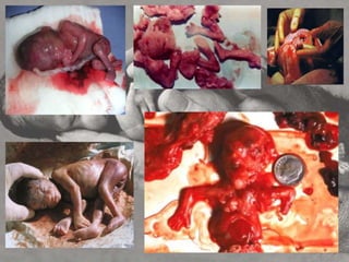  para dar fim à gestação que resultaria numa criança com problemas congênitos que seriam fatais ou associados com enfermidades graves[3]