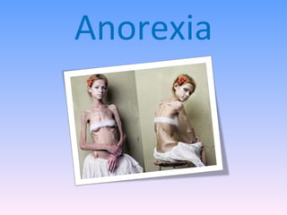 Anorexia 