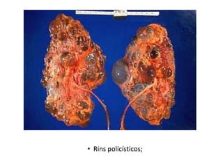  Defeitos urogenitais incluindo criptorquidia nos meninos; Punhos cerrados e as plantas arqueadas;