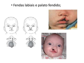 Defeitos cardíacos congênitos; Fendas labiais e palato fendido;