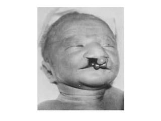 Tem como principal causa a não disjunção dos cormossomos durante a anáfase 1 da meiose, gerando gametas como 24 cromátides;