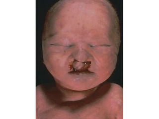 Ocorre na maioria das vezes com mulheres com idade avançada, apartir dos 35 anos acima;