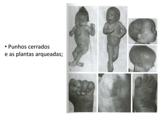 Sistema nervoso central como arrinencefalia; 