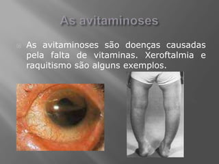    As avitaminoses são doenças causadas
    pela falta de vitaminas. Xeroftalmia e
    raquitismo são alguns exemplos.
 