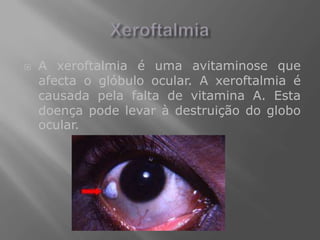    A xeroftalmia é uma avitaminose que
    afecta o glóbulo ocular. A xeroftalmia é
    causada pela falta de vitamina A. Esta
    doença pode levar à destruição do globo
    ocular.
 