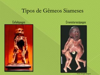 Cefalópagos

Craniotoracópagos

Fonte: Google Imagens

 