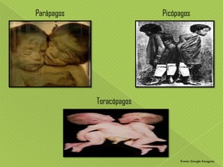 Parápagos

Picópagos

Toracópagos

Fonte: Google Imagens

 