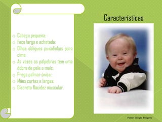 Características
o Cabeça pequena;
o Face larga e achatada;
o Olhos oblíquos puxadinhos para
cima;
o As vezes as pálpebras tem uma
dobra de pele a mais;
o Prega palmar única;
o Mãos curtas e largas;
o Discreta flacidez muscular.

Fonte: Google Imagens

 