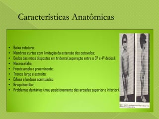 •
•
•
•
•
•
•
•
•

Baixa estatura;
Membros curtos com limitação da extensão dos cotovelos;
Dedos das mãos dispostos em tridente(separação entre o 3º e 4º dedos);
Macrocefalia;
Fronte ampla e proeminente;
Tronco largo e estreito;
Cifose e lordose acentuadas;
Braquidactilia;
Problemas dentários (mau posicionamento das arcadas superior e inferior).

 