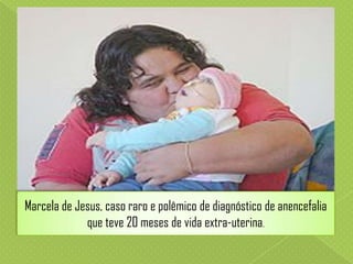 Marcela de Jesus, caso raro e polêmico de diagnóstico de anencefalia
que teve 20 meses de vida extra-uterina.

 