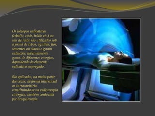 Os isótopos radioativos
(cobalto, césio, irídio etc.) ou
sais de rádio são utilizados sob
a forma de tubos, agulhas, fios,
sementes ou placas e geram
radiações, habitualmente
gama, de diferentes energias,
dependendo do elemento
radioativo empregado.
São aplicados, na maior parte
das vezes, de forma intersticial
ou intracavitária,
constituindo-se na radioterapia
cirúrgica, também conhecida
por braquiterapia.
 