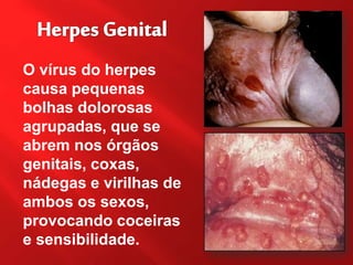 O vírus do herpes
causa pequenas
bolhas dolorosas
agrupadas, que se
abrem nos órgãos
genitais, coxas,
nádegas e virilhas de
ambos os sexos,
provocando coceiras
e sensibilidade.
 
