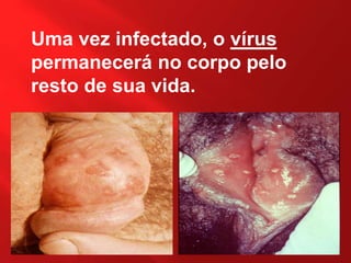 Uma vez infectado, o vírus
permanecerá no corpo pelo
resto de sua vida.
 