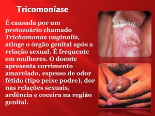 É causada por um
protozoário chamado
Trichomonas vaginalis,
atinge o órgão genital após a
relação sexual. É frequente
em mulheres. O doente
apresenta corrimento
amarelado, espesso de odor
fétido (tipo peixe podre), dor
nas relações sexuais,
ardência e coceira na região
genital.
 
