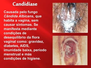 Causada pelo fungo
Cândida Albicans, que
habita a vagina, sem
causar sintomas. Se
manifesta mediante
condições de
desequilíbrio da flora
vaginal como: gravidez,
diabetes, AIDS,
imunidade baixa, período
menstrual e más
condições de higiene.
 