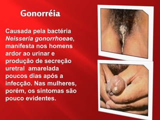 Causada pela bactéria
Neisseria gonorrhoeae,
manifesta nos homens
ardor ao urinar e
produção de secreção
uretral amarelada
poucos dias após a
infecção. Nas mulheres,
porém, os sintomas são
pouco evidentes.
 