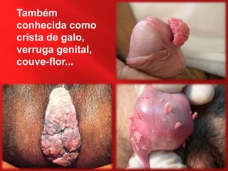 Também
conhecida como
crista de galo,
verruga genital,
couve-flor...
 