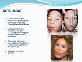 BOTULISMO 
 O botulismo é uma 
doença rara, porém grave, 
causada pela bactéria 
Clostridium botulinum 
 Contágio: alimentos 
contaminados por 
TOXINA produzida pelas 
bactérias (enlatados e 
conservas) 
 Sintomas: alterações 
neurológicas,(insuficiênci 
a respiratória), paralisia 
dos músculos 
 TOXINA botulínica: 
BOTOX 
 