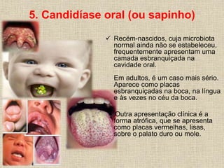 5. Candidíase oral (ou sapinho) 
 Recém-nascidos, cuja microbiota 
normal ainda não se estabeleceu, 
frequentemente apresentam uma 
camada esbranquiçada na 
cavidade oral. 
Em adultos, é um caso mais sério. 
Aparece como placas 
esbranquiçadas na boca, na língua 
e às vezes no céu da boca. 
Outra apresentação clínica é a 
forma atrófica, que se apresenta 
como placas vermelhas, lisas, 
sobre o palato duro ou mole. 
 