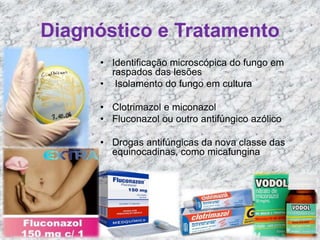 Diagnóstico e Tratamento 
• Identificação microscópica do fungo em 
raspados das lesões 
• Isolamento do fungo em cultura 
• Clotrimazol e miconazol 
• Fluconazol ou outro antifúngico azólico 
• Drogas antifúngicas da nova classe das 
equinocadinas, como micafungina 
 