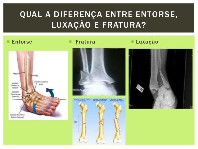 Luxação de tornozelo e pé