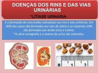 DOENÇAS DOS RINS E DAS VIAS
URINÁRIAS
*LITÍASE URINÁRIA*
E a formação de concreções calculosas nos rins e vias urinárias. Em
90% dos casos são formados por sais de cálcio e os restantes 10%
são formados por ácido úrico e cistina.
*A ultra-sonografia e o exame de urina são indicados.
 