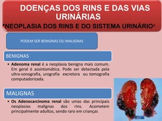 DOENÇAS DOS RINS E DAS VIAS
URINÁRIAS
*NEOPLASIA DOS RINS E DO SISTEMA URINÁRIO*
PODEM SER BENIGNAS OU MALIGNAS
BENIGNAS
• Adenoma renal é a neoplasia benigna mais comum.
Em geral é assintomática. Pode ser detectada pela
ultra-sonografia, urografia excretora ou tomografia
computadorizada.
MALIGNAS
• Os Adenocarcinoma renal são umas das principais
neoplasias malignas dos rins. Acometem
principalmente adultos, sendo raro em crianças
 