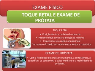 TOQUE RETAL
• Posição de sims ou lateral esquerda
• Paciente deve esvaziar a bexiga ao máximo
• Inspeciona-se a região anuperineal
• *Introduz o do dedo em movimentos lentos e rotatórios
EXAME DE PRÓSTATA
• Com a finalidade de analisar o tamanho, a consistência, a
superfície, os contornos, o sulco mediano e a mobilidade da
próstata.
EXAME FÍSICO
TOQUE RETAL E EXAME DE
PRÓTATA
 