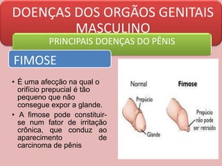 DOENÇAS DOS ORGÃOS GENITAIS
MASCULINO
PRINCIPAIS DOENÇAS DO PÊNIS
FIMOSE
• É uma afecção na qual o
orifício prepucial é tão
pequeno que não
consegue expor a glande.
• A fimose pode constituir-
se num fator de irritação
crônica, que conduz ao
aparecimento de
carcinoma de pênis
 
