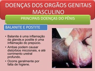 DOENÇAS DOS ORGÃOS GENITAIS
MASCULINO
PRINCIPAIS DOENÇAS DO PÊNIS
BALANITE E POSTITE
• Balanite é uma inflamação
da glande,e postite é uma
inflamação do prepúcio.
• Ambas podem causar
distúrbios miccionais, e até
corrimento uretral
profundo.
• Ocorre geralmente por
falta de higiene.
 