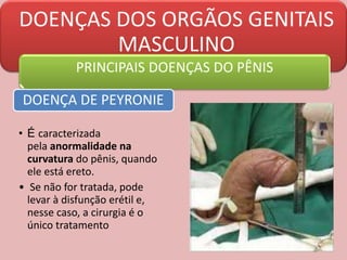 DOENÇAS DOS ORGÃOS GENITAIS
MASCULINO
PRINCIPAIS DOENÇAS DO PÊNIS
DOENÇA DE PEYRONIE
• É caracterizada
pela anormalidade na
curvatura do pênis, quando
ele está ereto.
• Se não for tratada, pode
levar à disfunção erétil e,
nesse caso, a cirurgia é o
único tratamento
 