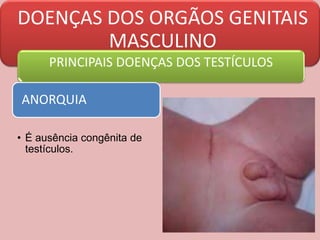 DOENÇAS DOS ORGÃOS GENITAIS
MASCULINO
PRINCIPAIS DOENÇAS DOS TESTÍCULOS
ANORQUIA
• É ausência congênita de
testículos.
 