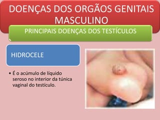 DOENÇAS DOS ORGÃOS GENITAIS
MASCULINO
PRINCIPAIS DOENÇAS DOS TESTÍCULOS
HIDROCELE
• É o acúmulo de líquido
seroso no interior da túnica
vaginal do testículo.
 