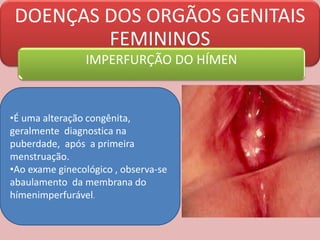 DOENÇAS DOS ORGÃOS GENITAIS
FEMININOS
IMPERFURÇÃO DO HÍMEN
•É uma alteração congênita,
geralmente diagnostica na
puberdade, após a primeira
menstruação.
•Ao exame ginecológico , observa-se
abaulamento da membrana do
hímenimperfurável.
 