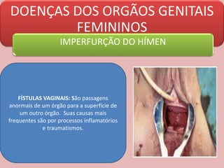 DOENÇAS DOS ORGÃOS GENITAIS
FEMININOS
IMPERFURÇÃO DO HÍMEN
FÍSTULAS VAGINAIS: São passagens
anormais de um órgão para a superfície de
um outro órgão. Suas causas mais
frequentes são por processos inflamatórios
e traumatismos.
 