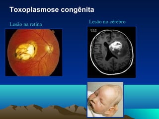 Toxoplasmose congênita
Lesão na retina
Lesão no cérebro
 