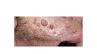 hpv.pptx