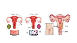 hpv.pptx