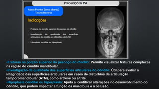 •Fraturas na porção superior do pescoço do côndilo: Permite visualizar fraturas complexas
na região do côndilo mandibular.
•Investigação da qualidade das superfícies articulares do côndilo: Útil para avaliar a
integridade das superfícies articulares em casos de distúrbios da articulação
temporomandibular (ATM), como artrose ou artrite.
•Hipoplasia condilar ou hiperplasia: Ajuda a identificar alterações no desenvolvimento do
côndilo, que podem impactar a função da mandíbula e a oclusão.
 