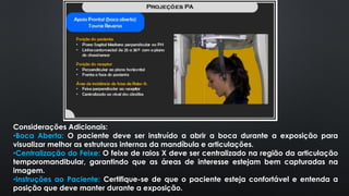 Considerações Adicionais:
•Boca Aberta: O paciente deve ser instruído a abrir a boca durante a exposição para
visualizar melhor as estruturas internas da mandíbula e articulações.
•Centralização do Feixe: O feixe de raios X deve ser centralizado na região da articulação
temporomandibular, garantindo que as áreas de interesse estejam bem capturadas na
imagem.
•Instruções ao Paciente: Certifique-se de que o paciente esteja confortável e entenda a
posição que deve manter durante a exposição.
 