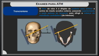O feixe de raios X é dirigido de posterior para anterior e
acima do meato acústico externo, passando superiormente
à parte petrosa do temporal, para atingir a cabeça da
mandíbula contralateral (de interesse)
 