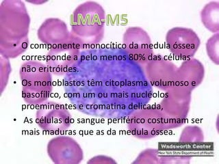 Mais de 90% das células mielóides damedula óssea são de células blásticas.O componente granulocítico/monocítico emmaturação não excede a 10% Os blastos têm tamanho médio ou grande, com um ou mais nucléolos, ocasionais bastonetes de Auer eraros grânulos citoplasmáticosLMA-M1 