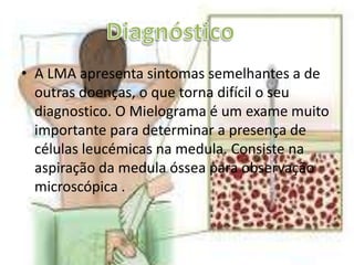  Os granulocítico em maturação é maiordo que 20% das células mielóides da medula óssea. O componente monocítico, desde mono blastos a monócitos, é maior do que 20% na medula Óssea.LMA-M4