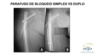 PARAFUSO DE BLOQUEIO SIMPLES VS DUPLO
 