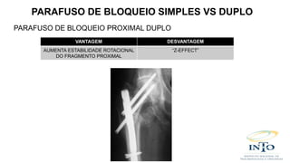 PARAFUSO DE BLOQUEIO PROXIMAL DUPLO
VANTAGEM DESVANTAGEM
AUMENTA ESTABILIDADE ROTACIONAL
DO FRAGMENTO PROXIMAL
“Z-EFFECT”
PARAFUSO DE BLOQUEIO SIMPLES VS DUPLO
 