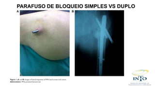 PARAFUSO DE BLOQUEIO SIMPLES VS DUPLO
 