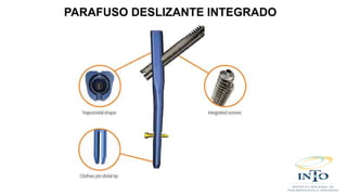 PARAFUSO DESLIZANTE INTEGRADO
 