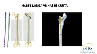 HASTE LONGA VS HASTE CURTA
 