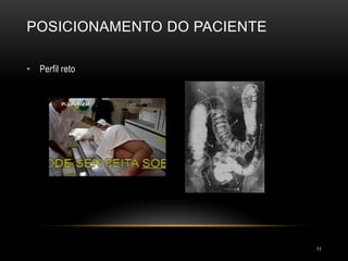 POSICIONAMENTO DO PACIENTE
11
• Perfil reto
 